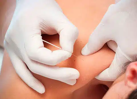 Terapia manual combinada con punción seca para tratar el dolor crónico