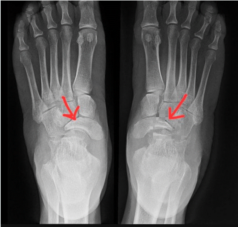 Ejercicio terapéutico para mejorar la movilidad en Müller-Weiss