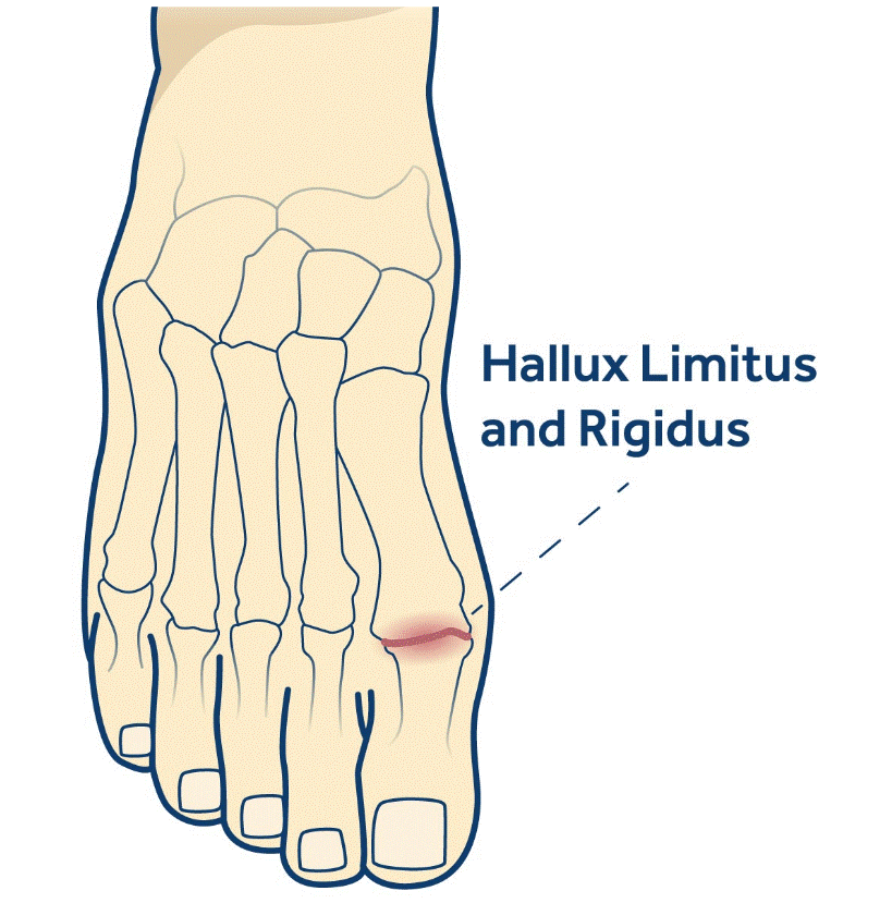 Evaluación biomecánica del hallux limitus y marcha alterada