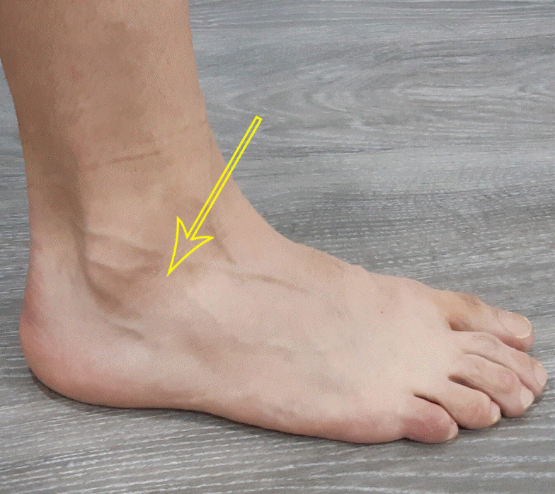 Plantillas personalizadas para mejorar la estabilidad en el síndrome del seno del tarso