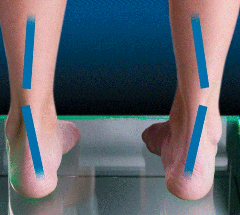 Evaluación biomecánica del pie supinado en consulta de fisioterapia