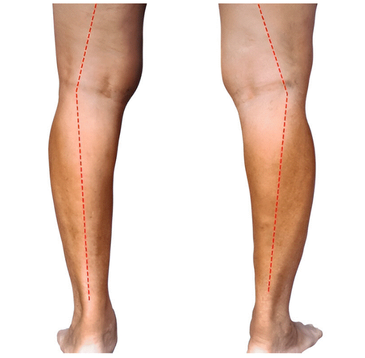 Evaluación fisioterapéutica de la tibia vara y pronación compensatoria