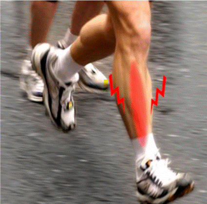Periostitis tibial y running
