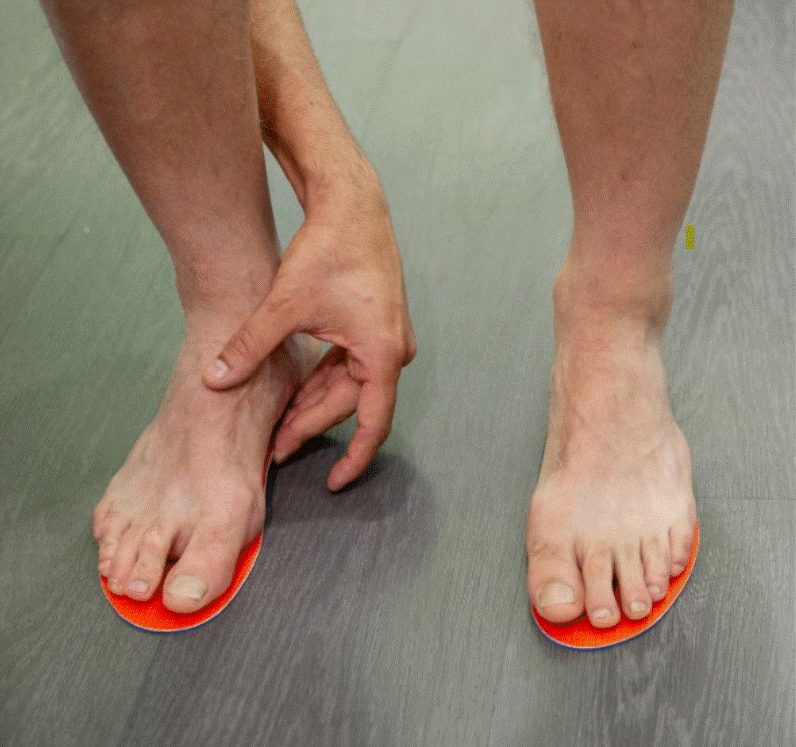 Plantillas personalizadas para el confort en pie plano sintomático