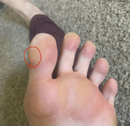 pinch callus en pronación