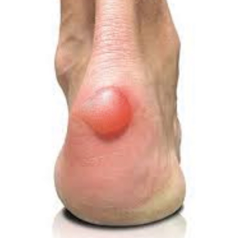 Deformidad de Haglund