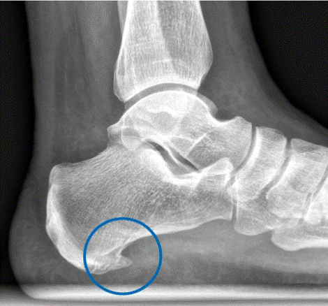 Causas del espolón calcáneo