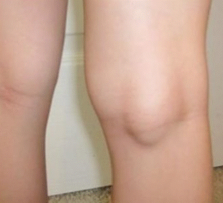 Quiste de Baker y dolor de rodilla