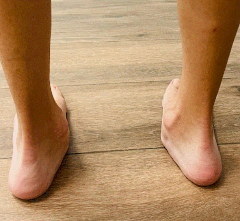 tendinopatía del tibial posterior