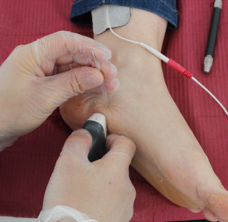 Tratar fascitis con electrolisis