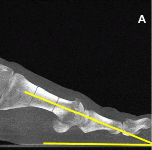 metatarsus primus elevatus