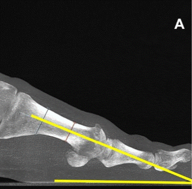 metatarsus primus elevatus