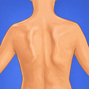 discinesia escapular