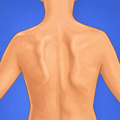 discinesia escapular