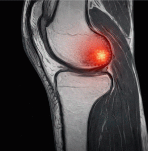 edema óseo subcondral de rodilla