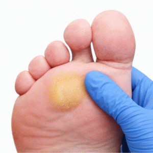 hiperqueratosis por presión