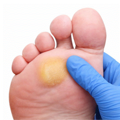 hiperqueratosis por presión