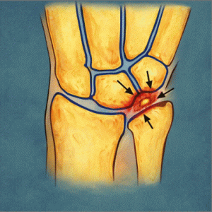 impactación ulnocarpiana