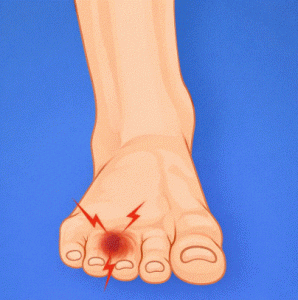 neuroma de Morton