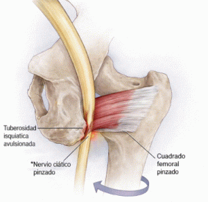 pinzamiento isquiofemoral