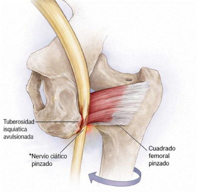 pinzamiento isquiofemoral