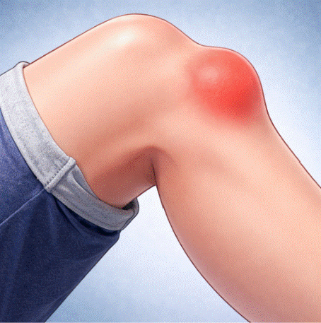 bursitis prerrotuliana