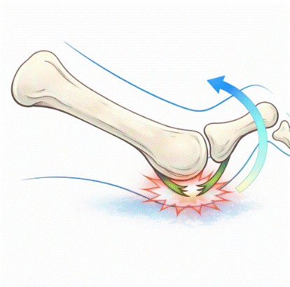 lesión de la placa plantar