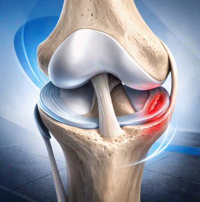 lesión meniscal deportiva