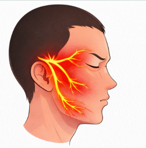 neuralgia del trigémino