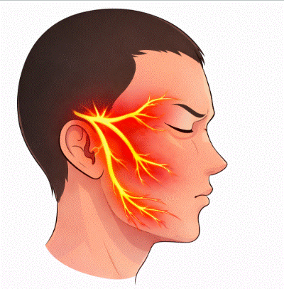 neuralgia del trigémino