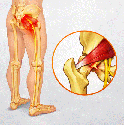 síndrome del piriforme