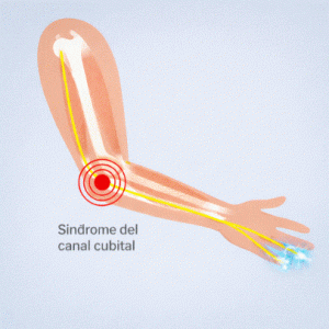síndrome del túnel cubital
