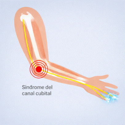 síndrome del túnel cubital