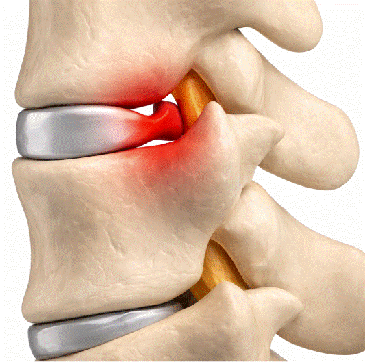 discapacidad por hernia discal cervical