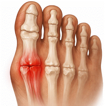 sesamoiditis del pie