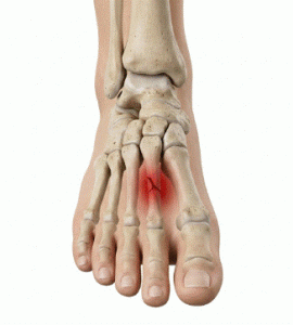 fractura de estrés del metatarsiano