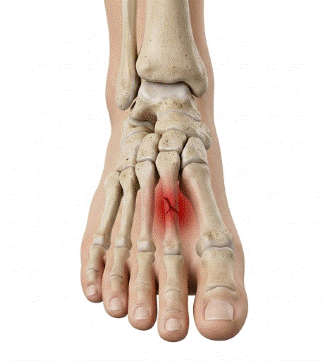 fractura de estrés del metatarsiano