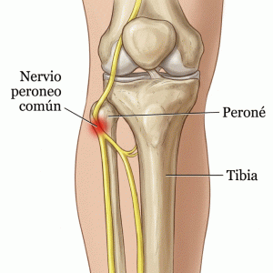 parálisis del nervio peroneo